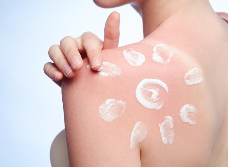 Comment se préparer avant l’été pour éviter les coups de soleil ?